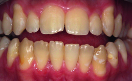 Open beet na orthodontische behandeling