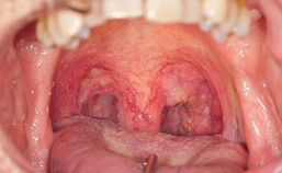 Orofarynxcarcinoom in tonsilgebied links