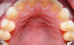 Erosieve tandslijtage door frequent braken