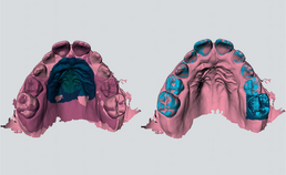 Superimpositie van 2 intraorale scans van de bovenkaak