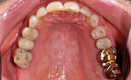 Occlusaal aanzicht maxillaire dentitie bij drogemondklachten
