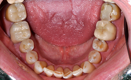 Occlusaal aanzicht mandibulaire dentitie bij drogemondklachten