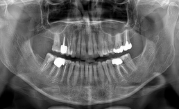 PAN van dentitie vrouw met drogemondklachten