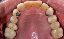 Occlusaal aanzicht maxillaire dentitie bij droge mond 