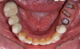 Occlusaal aanzicht mandibulaire dentitie bij droge mond