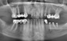 PAN van dentitie man met drogemondklachten en bipolaire stoornis