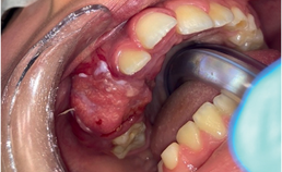 Plaveiselcelcarcinoom in mondholte bij kinderen (2)