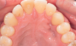 Gingivadefect blijkt een centraal dentogeen fibroom (a)