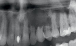  Gingivadefect blijkt een centraal dentogeen fibroom (c)