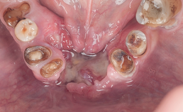 Ulcerende tumoreuze masse is plaveiselcelcarcinoom