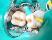 Partiële pulpotomie bij permanente molaren