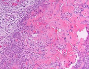 Dentinogene ghost cell-tumor in de onderkaak