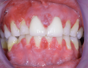 Orale graft-versus-hostziekte: implicaties voor mondzorgverleners