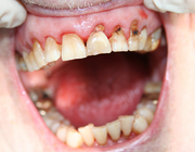 Desolate dentitie als gevolg van wortelcariës