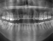 Wortelresorptie als gevolg van orthodontische behandeling