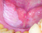 Onderkenning van gedifferentieerde dysplasie voor het voorspellen van de kans op maligne ontaarding van orale leukoplakie