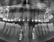 Chirurgisch oprichten van deels geïmpacteerde tweede molaren