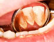Heeft voeding invloed op de vorming van tandsteen?
