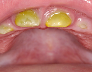 Groene tandverkleuring bij een peuter