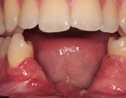 Reconstructie van de mandibula na verlies van het middensegment door een odontogeen myxoom