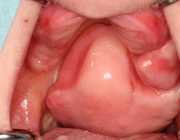 Een maxillaire gigantiforme fibro-epitheliale poliep: een brok in de keel