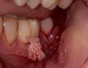 De dentogene ontsteking: diagnose, beloop en behandeling
