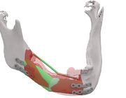 Serie: Innovatieve technieken en ontwikkelingen in de mondzorg. 3D-planning in de mka-chirurgie