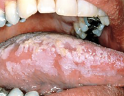 Witte afwijking van het mondslijmvlies: leukoplakie