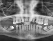 Dentale rehabilitatie bij jonge patiënt met glycogeenstapelingsziekte type 1B