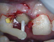 Chirurgische extrusie, een alternatief voor een tandheelkundig implantaat?