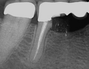 Wortelresectie: tandbehoud door problemen bij de wortel aan te pakken