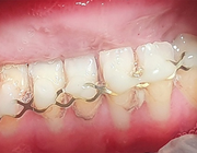 Een uitdagende tandheelkundige behandeling van een patiënt met spinale musculaire atrofie