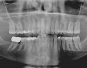 TMD-klachten na een tandheelkundige behandeling