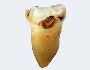 Hypodontia en retentie van derde molaren in Noorse middeleeuwse skeletten