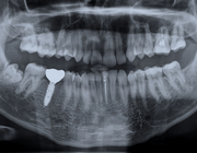 Implantaatverlies: 6 mm versus 10 mm implantaten