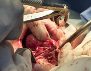 Orale leukoplakie bij behandelde patiënten met een plaveiselcelcarcinoom