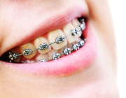 De optimale kracht voor orthodontische tandverplaatsing