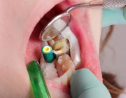 Hechten van glasionomeercement en adhesieven aan voorbehandeld dentine