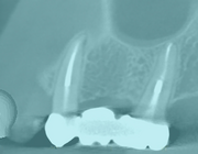CBCT in de endodontologie: wanneer wel of niet? Periapicale lucenties en extra wortelkanalen 
