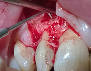 Endodontische herbehandeling of apexresectie: is een evidencebased keuze mogelijk?