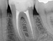 Endodontologie in beweging: nieuwe concepten, materialen en technieken 5. De dynamiek van de periapicale laesie