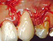 Gingivarecessies en parodontale plastische chirurgie