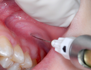 Dentogene pijnklachten