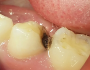 Preventieve tandheelkunde 9. Niet-Restauratieve Caviteitsbehandeling: voortschrijdend inzicht of controversieel?