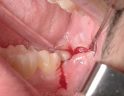 Incisietechnieken bij verwijdering van geïmpacteerde derde molaren in de onderkaak