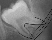Serie: Hora est. Prechirurgisch onderzoek van mandibula en canalis mandibularis met CBCT-scans