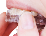 Mogelijkheden en beperkingen van orthodontische behandeling met clear aligners. Een verkenning