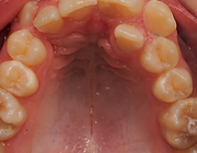 Orthodontische behandeling van een malocclusie met een gecompromitteerde centrale bovenincisief