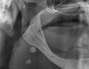 Herkenning van wekedelen–opaciteiten op een panoramische röntgenopname: idiopathische calcificaties