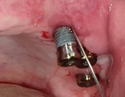 AB-profylaxe en (pre)implantologische chirurgie